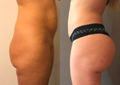 Lipofilling des fesses