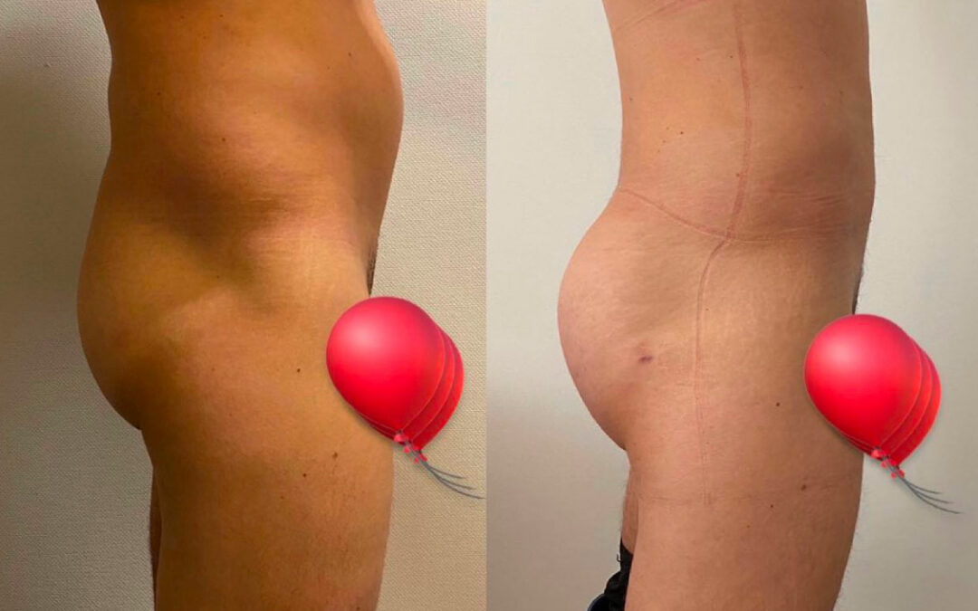 Lipofilling des fesses
