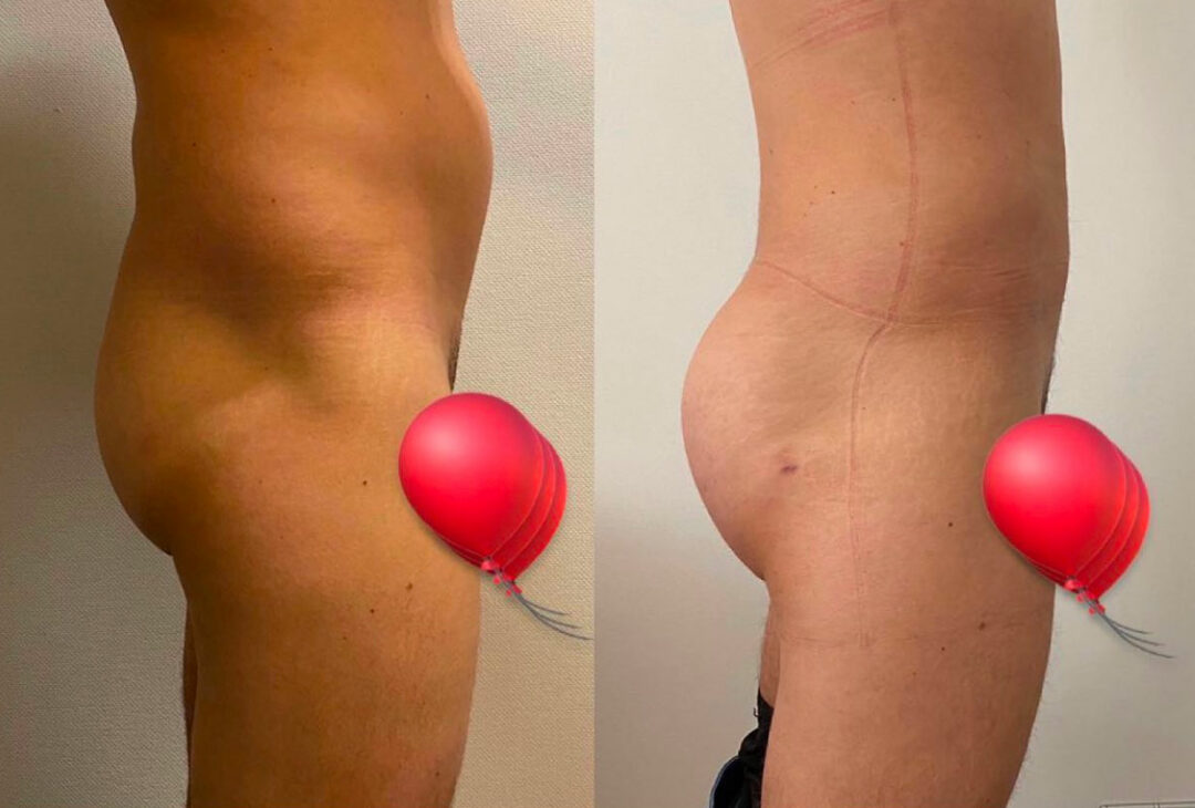 Lipofilling des fesses