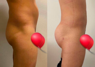 Lipofilling des fesses