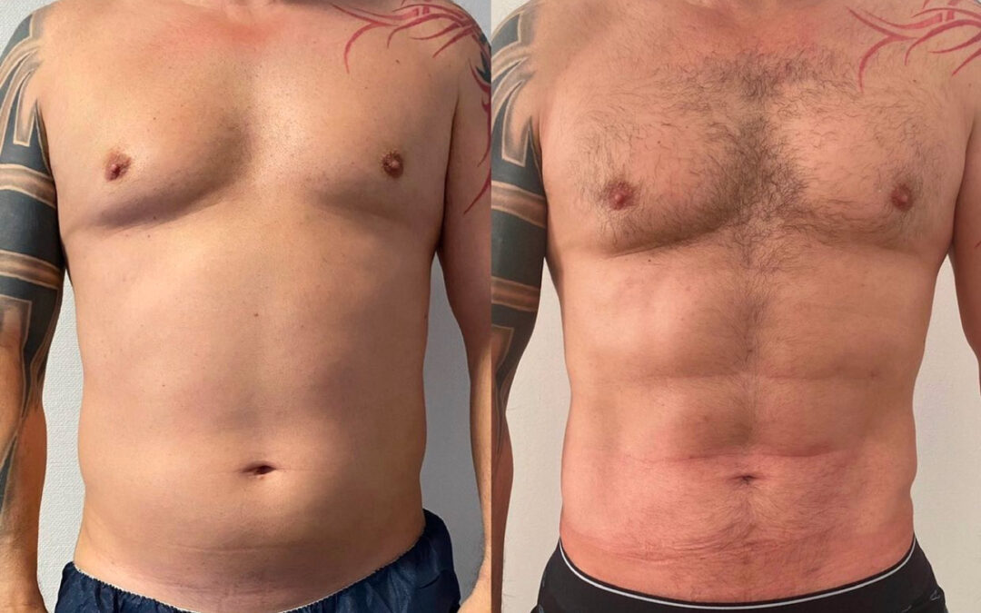 Liposuccion abdominale