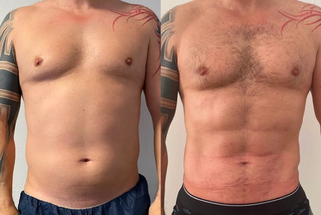 Liposuccion abdominale