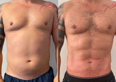 Liposuccion abdominale