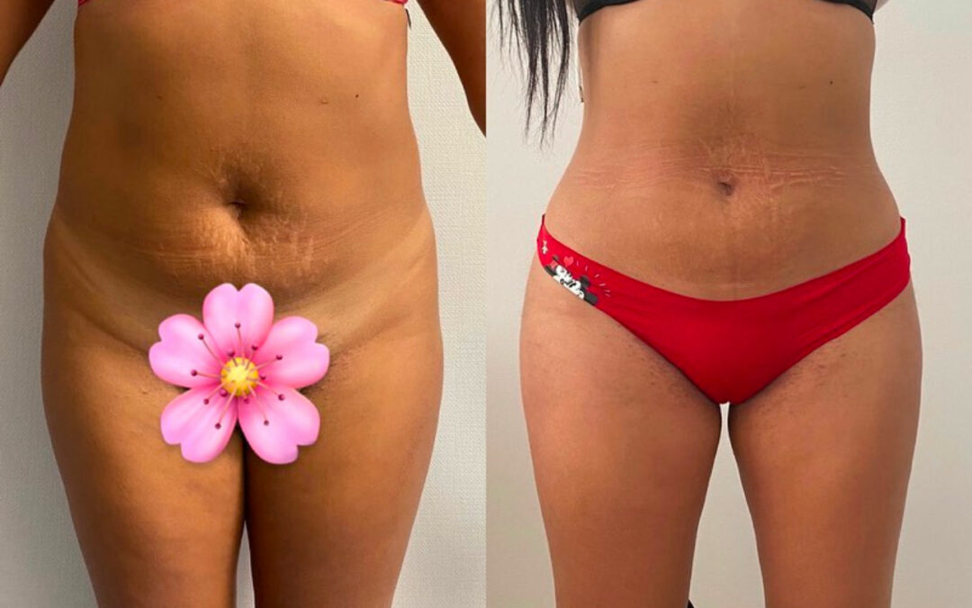 Plastie abdominale