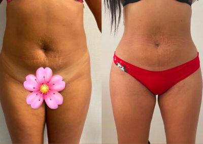 Plastie abdominale