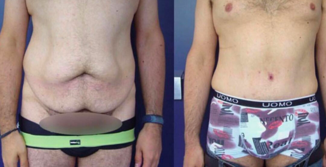 Plastie abdominale
