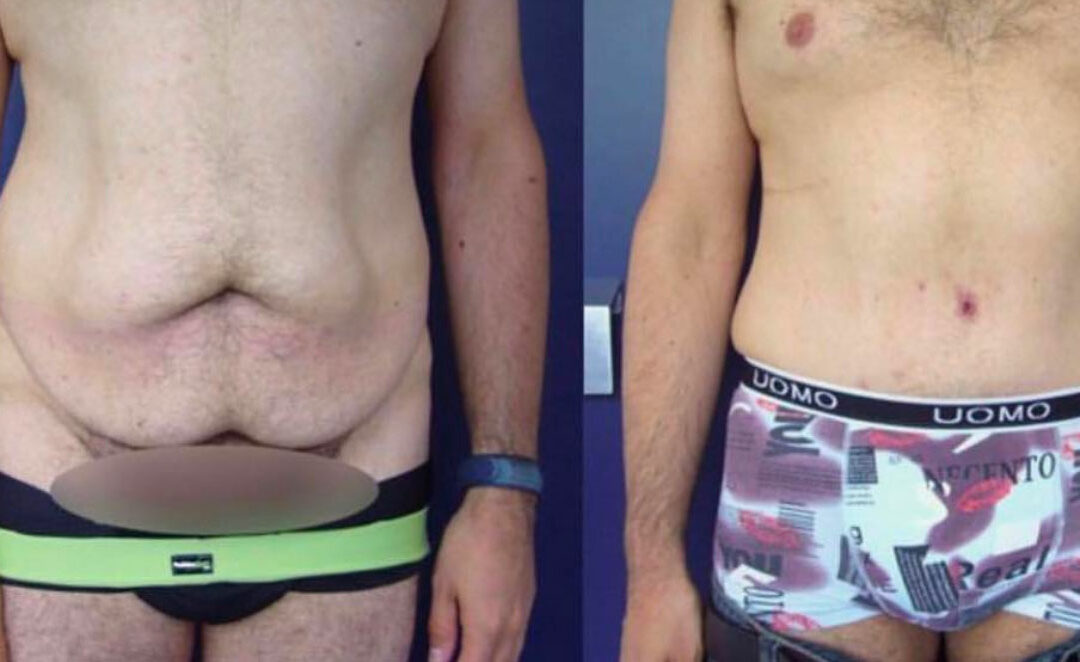 Plastie abdominale