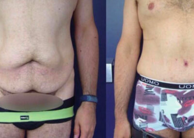 Plastie abdominale