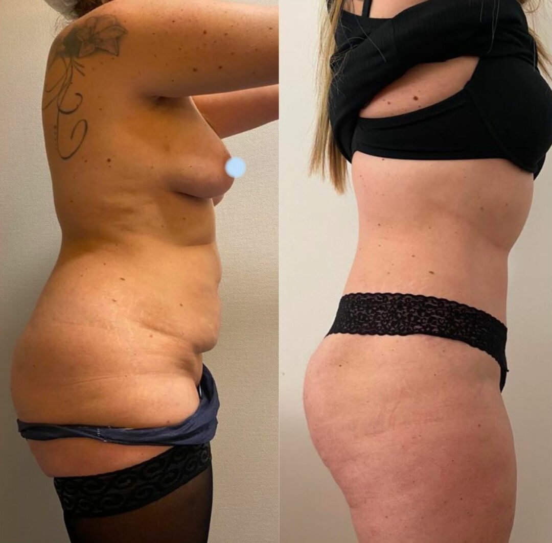 Plastie abdominale