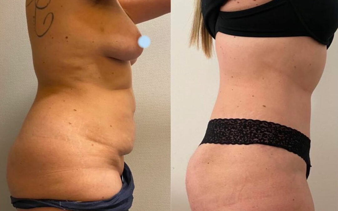 Plastie abdominale