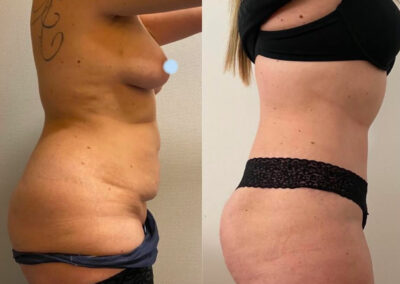 Plastie abdominale