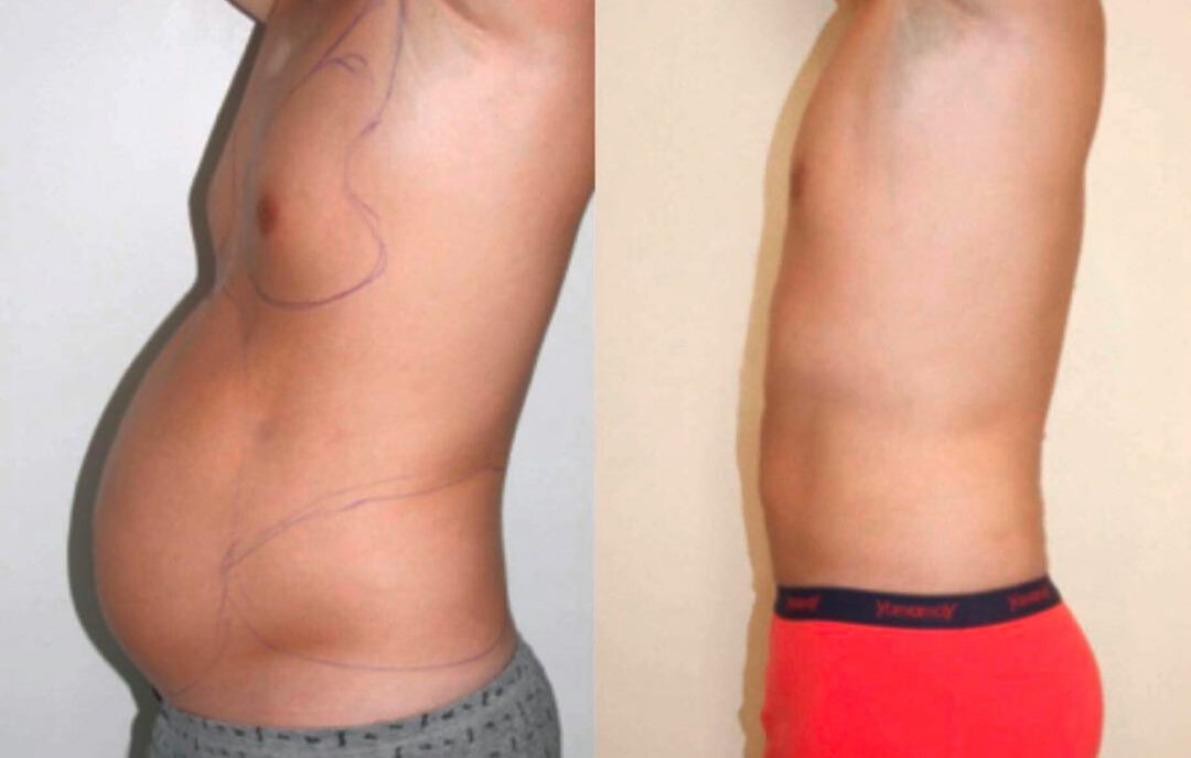 Liposuccion