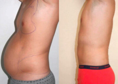 Liposuccion