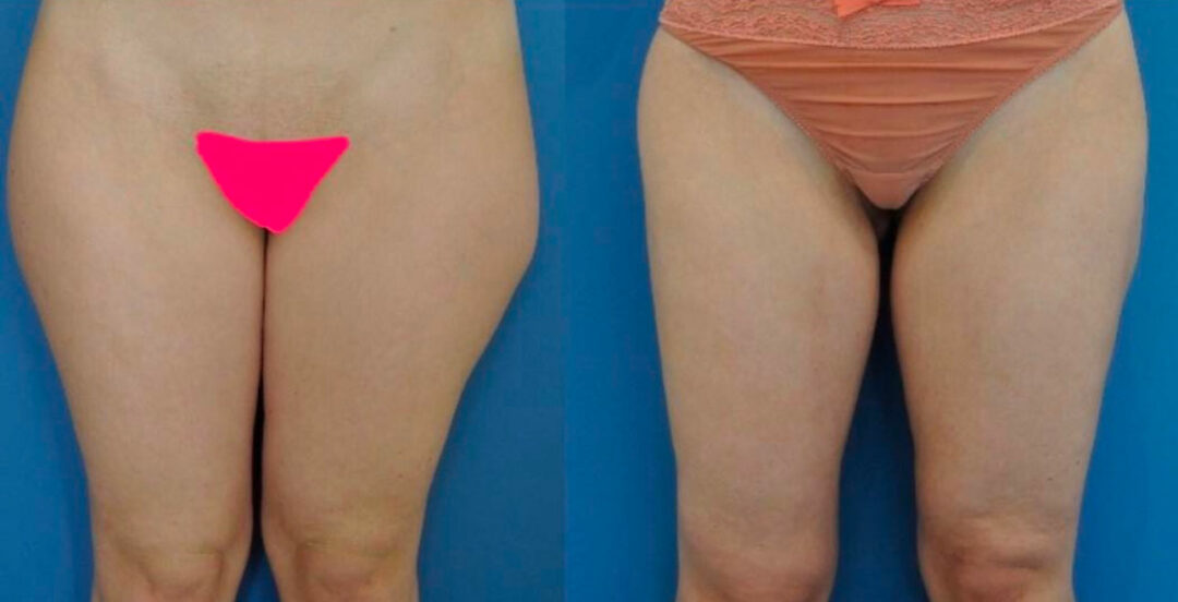Liposuccion des cuisses