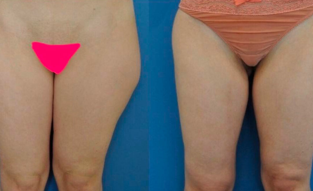 Liposuccion des cuisses