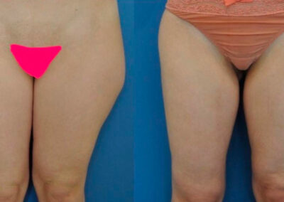 Liposuccion des cuisses
