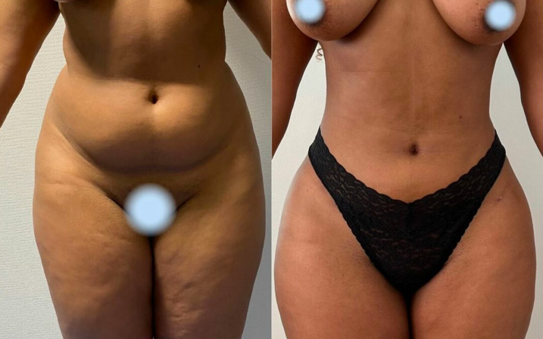 Liposuccion du ventre et des flancs