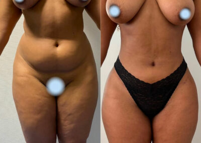 Liposuccion du ventre et des flancs