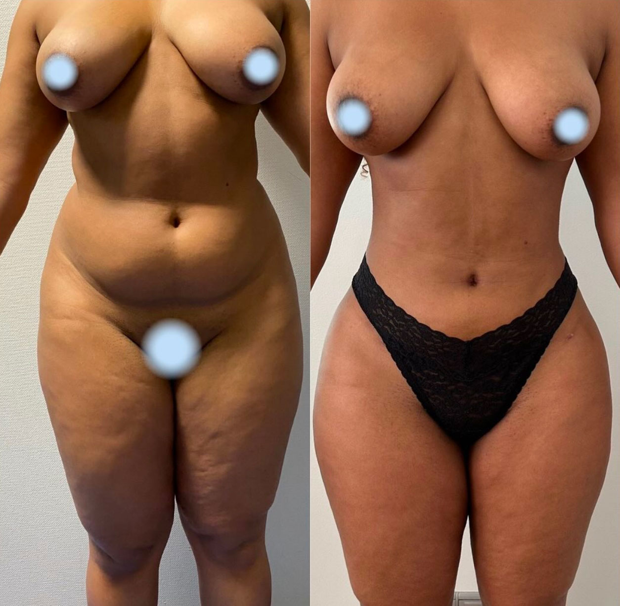 liposuccion-ventre Liposuccion